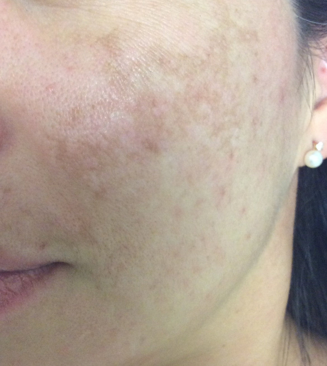 Managing Facial Pigmentation